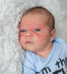 דלקת בעור הפנים - תמונת אווירה